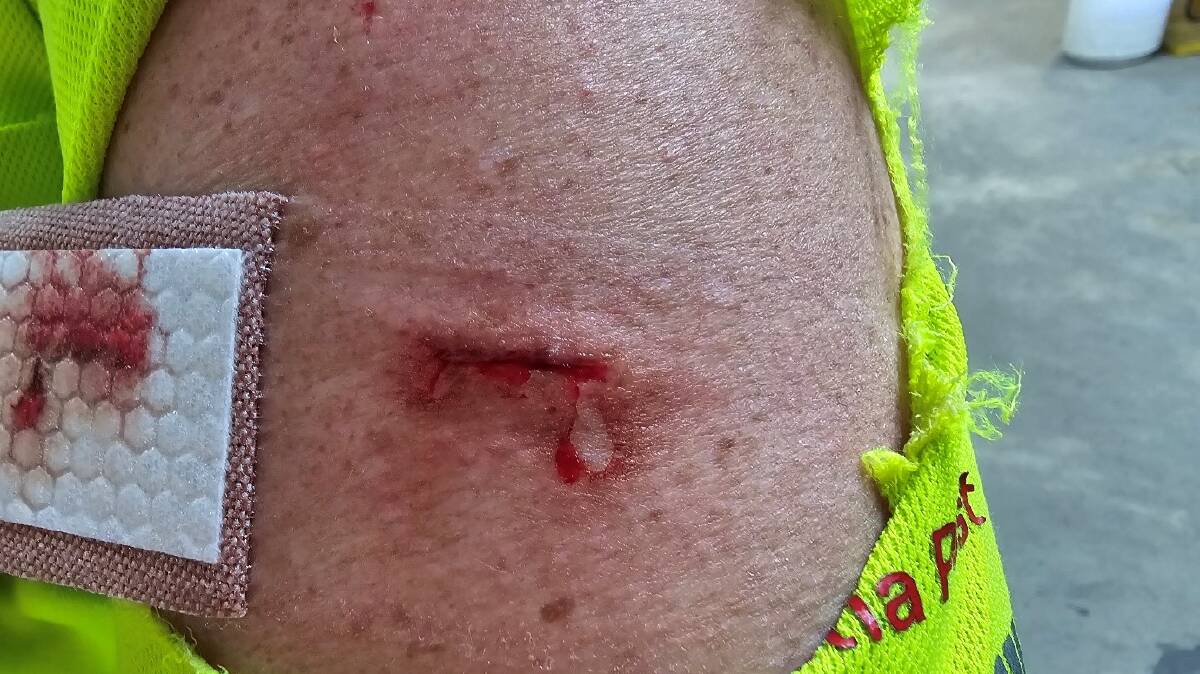 Australia Post shared an image of an injury sustained in a dog-related incident. Supplied Australia Post shared an image of an injury sustained in a dog-related incident. Supplied
